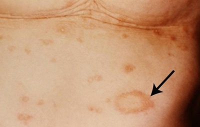 Дерматофития гладкой кожи может поражать как открытые участки тела, так и крупные складки