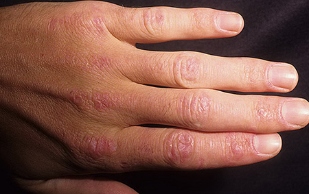 Заболевание характеризуется негнойным воспалением соединительной ткани, но у 30% пациентов кожный синдром отсутствует, что затрудняет диагностику
