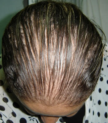 Известно, что в нормальных условиях человек может потерять за сутки примерно сто волос. При патологии можно потерять значительное большее количество волос, до 1000 штук, то есть практически происходит облысение.