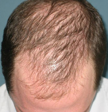 Диффузная алопеция – одно из самых распространенных заболеваний. Происходит быстрая потеря волос и снижение их густоты.