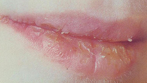 Хейлит поражает кожу губ, а именно – красную кайму, при этом появляются крупные чешуйки, под которыми находится воспаленный эпидермис
