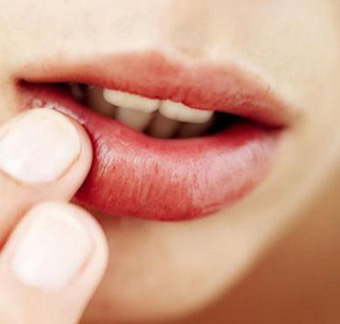 Наружно необходимо смазывать губы жирными мазями и гигиенической помадой без отдушек, чтобы уменьшить образование корочек
