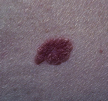 При появлении небольшого образования на коже необходимо обратиться к дерматологу, это может быть первый симптом рака кожи