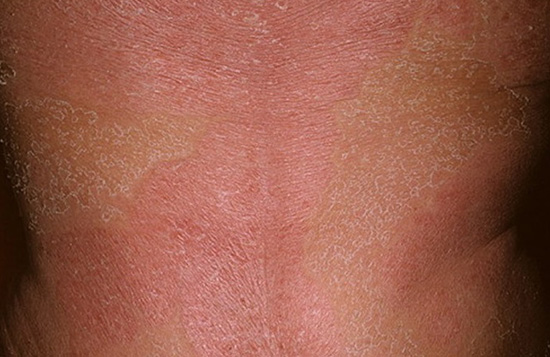Характерные симптомы эритродермии – покраснение, шелушение кожи