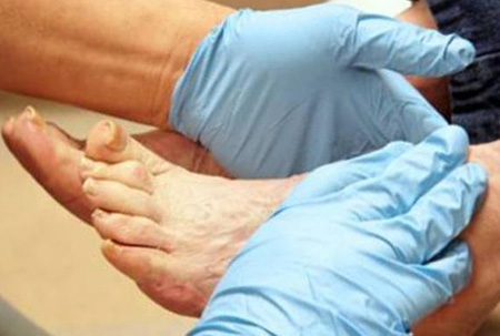 Одно из самых опасных осложнений диабетической стопы – флегмона. Своевременное обращение к специалистам поможет сохранить ногу.