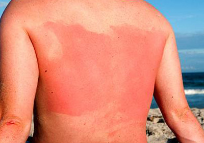 Покраснение кожи может являться следствием солнечного ожога