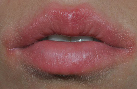 Аллергическая форма болезни проявляется сильной отечностью губ, их жжением, вздутием