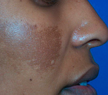 В странах Азии у коренного населения наблюдается «бронзовая хлоазма», проявляющаяся на лице, шейной и грудной зонах