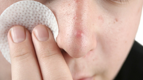Карбункулы могут появиться на любом участке тела, в редких случаях очаг воспаления находится на лице