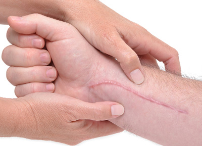 Если на старом шраме или рубце появляются признаки воспаления, то это повод срочно посетить специалиста