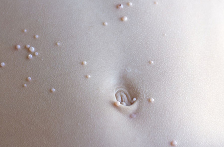 Контагиозный моллюск – в основном детское заболевание. Чаще всего инфекция поражает кожные покровы детей с ослабленным иммунитетом.