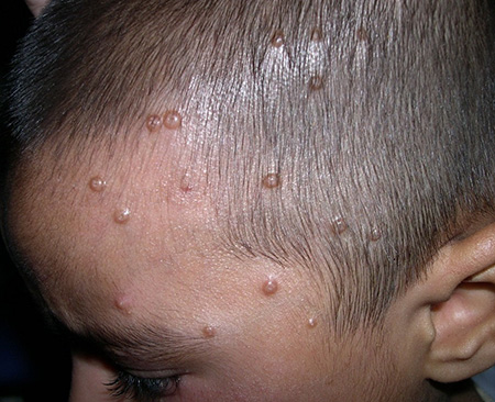 Вирусные высыпания контагиозного моллюска у взрослых чаще всего наблюдаются в районе паховой области. У детей сыпь появляется на лице, веках, животе.
