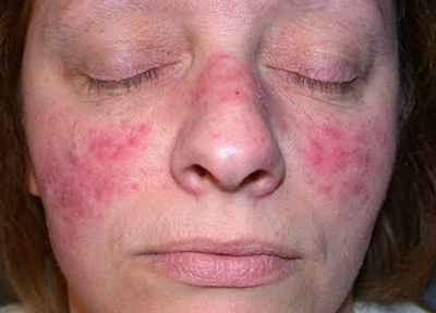 Системная красная волчанка нередко способствует развитию предраковых заболеваний кожных покровов