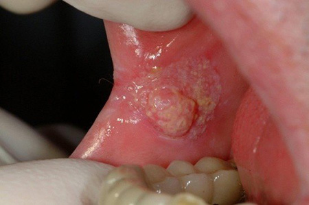 Поражение слизистой оболочки полости рта зачастую остаётся незамеченным дольше, чем повреждение кожи