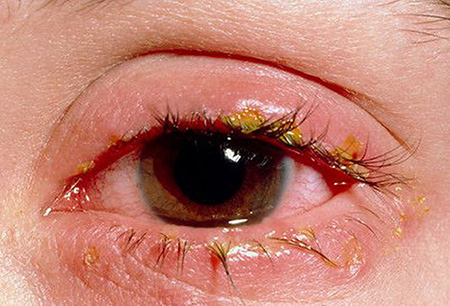 Просыпаясь, трудно открыть глаза? Срочно необходимо посетить дерматолога, потому что такой симптом может сигнализировать о развитии демодекоза.