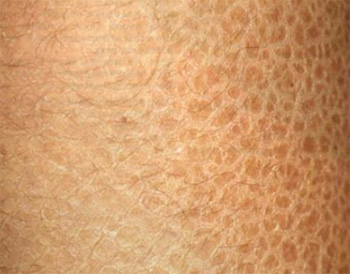 У больных ихтиозом нарушен процесс ороговения кожи. Она покрыта чешуей, похожей на рыбью