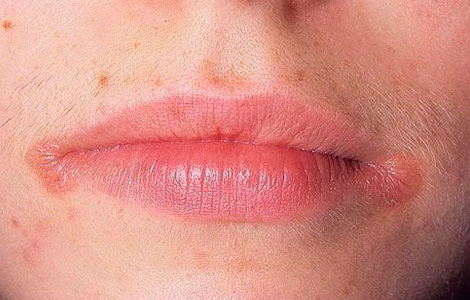 Кандидоз углов рта (заеда) - в местах складок рта появляются болезненые трещинки, которые долго заживают