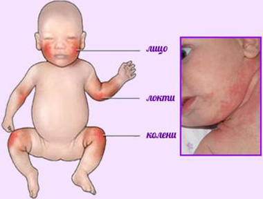 Кандидоз у детей (так называемый пеленочный дерматит). Сопровождается мокнущей кожей, отеками, опухолями. 