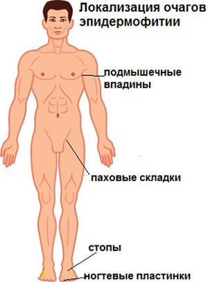 Типичные области тела, подверженные инфицированию грибком
