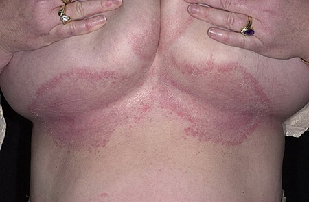 У полных женщин паховая эпидермофития чаще поражает кожу под молочными железами
