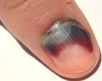 При повреждении ногтя зачастую под ним начинается развитие патологического процесса