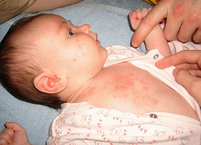 Сыпь на теле новорожденного чаще всего является потницей