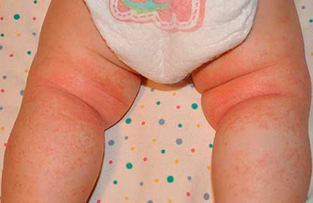 Чаще всего потница развивается в естественных складках кожи малыша – в области паха, ягодиц, на ножках