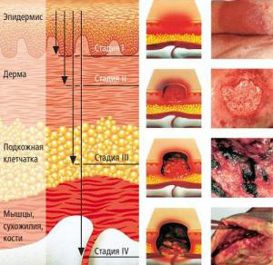 Стадии развития недуга и внешние проявления на коже. Видно, какую опасность представляет тяжелая форма заболевания.