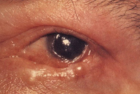 Пузырчатка глаз, или рубцующийся пемфигоид
