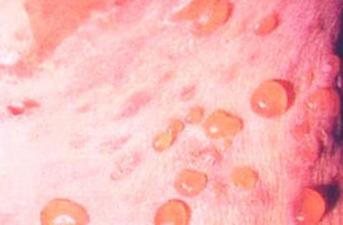 При буллезном пемфигоиде пузыри сливаются и образуют обширные участки поражения