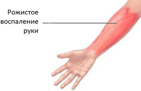 Рожистое воспаление руки – распространенное инфекционное заболевание, которое может передаваться воздушно-капельным путем. При проявлении первой симптоматики необходимо сразу обратиться к специалисту.