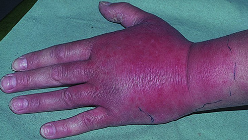 Рожистое воспаление руки – серьезное заболевание, которое может привести к необратимым последствиям и осложнениям. Диагностируется у больных разных возрастных категорий и полов. В большинстве случаев локализуется на руках и ногах.