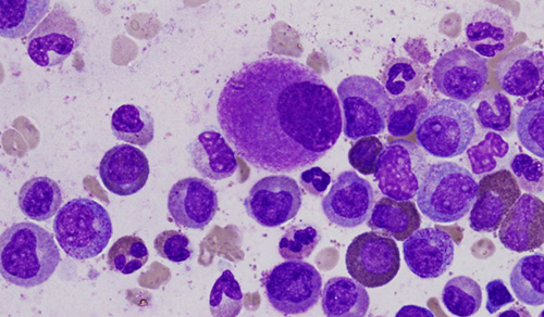 При данной патологии происходит патологическое увеличение числа тучных клеток. Вот так они выглядят под микроскопом.