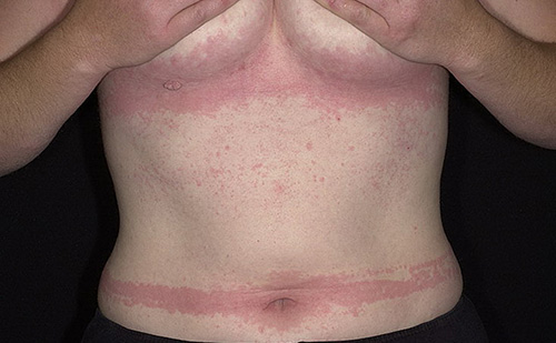 При мастоцитозе происходит сильное воспаление кожных покровов, как при обычной крапивнице, но за ним следуют осложнения и плачевные последствия