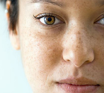 Пятна на щеках и носу – это не всегда веснушки, поэтому для устранения таких симптомов надо посетить дерматолога
