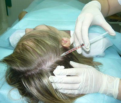 В сложных случаях для сохранения волосяного покрова необходимы инъекции непосредственно в область поражения