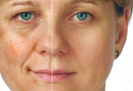 Биоревитализация обладает высокой эффективностью в отношении лечения разных кожных проблем