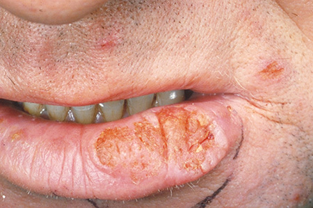 В основном плоскоклеточный рак локализуется на красной кайме нижней губы, в перианальной области, на наружных половых органах
