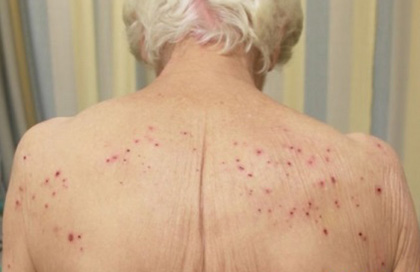 Естественное старение кожи с возрастом может привести к ее поражению