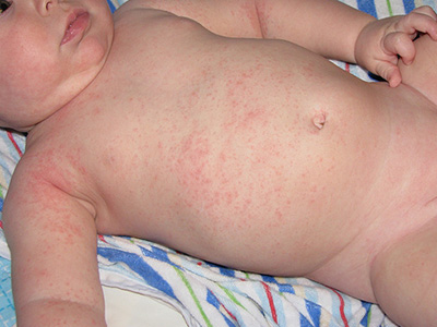 Основной симптом потницы у детей - это появление сыпи с покраснением