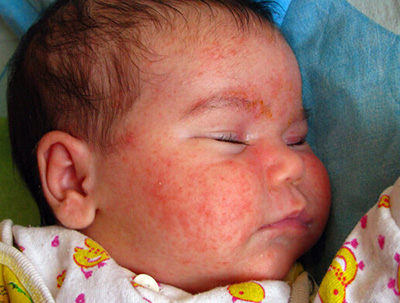 Если ребенок страдает аллергией, то красные высыпания в первую очередь появятся на лице