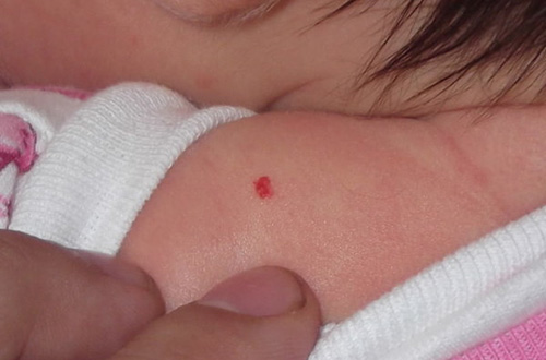 Красное пятно у новорожденного гемангиома