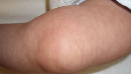 Мраморная кожа у ребенка при повышенной температуре
