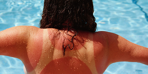 Частые солнечные ожоги значительно повышают вероятность развития опухолевых заболеваний кожи