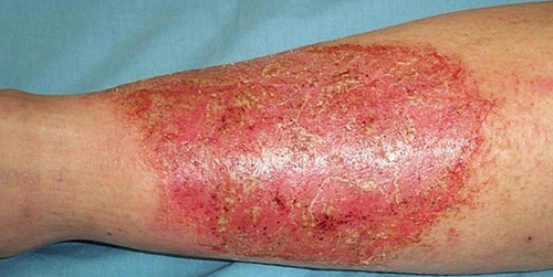 Наиболее подвержены инфекционному поражению кожи люди с пониженным иммунитетом, а также ослабленные стрессами и болезнями хронического характера