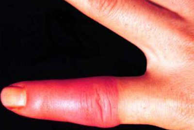 На кожном покрове изменения наблюдаются спустя 8-20 часов с момента проявления первых симптомов