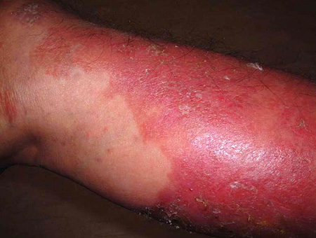 На фоне инфекционного процесса возможно появление гнойников, воспаление венозных стенок, отмирание кожной ткани