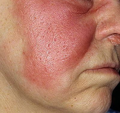 Воспаленные очаги могут наблюдаться на лице, в зоне наружного слухового прохода, волосистой части головы, на руках и ногах, вокруг операционных швов, в местах расчесов