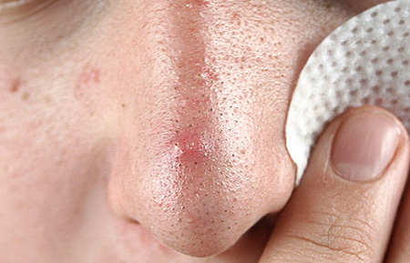 Уплотнение кожи на носу может стать первым признаком развития серьезного заболевания