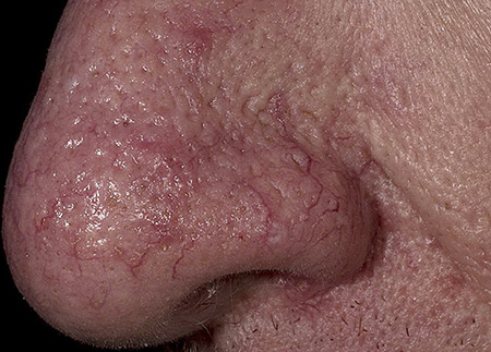 Если на коже носа стали сильно просвечивать кровеносные сосуды и появились небольшие шероховатости, то это уже повод поспешить к дерматологу